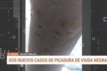 DOS NUEVOS CASOS DE PICADURA DE VIUDA NEGRA